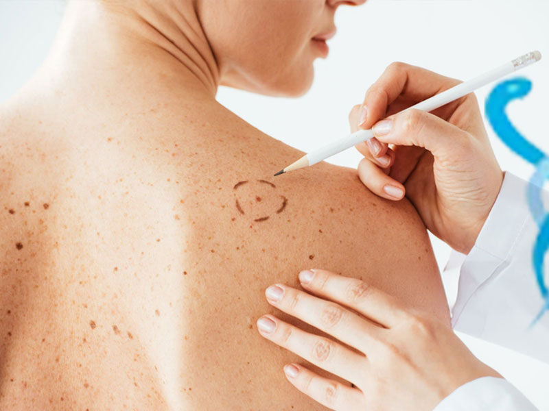 Plastik Cerrahi Cilt Kanseri